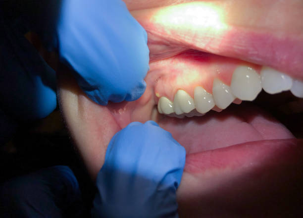 Best Chipped Tooth Repair Near Me  in Decatur, IL